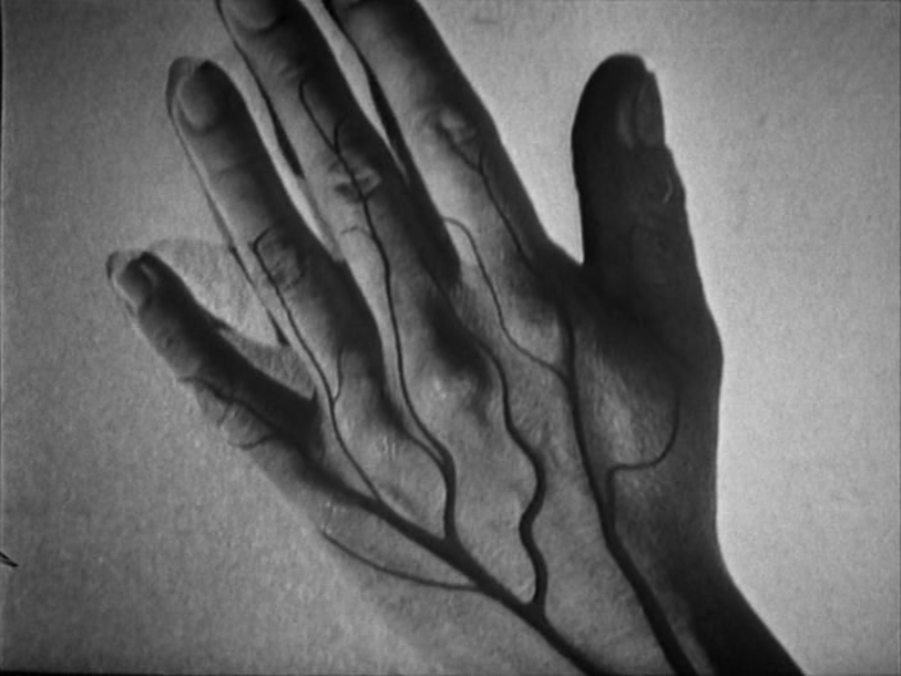 Hand with black vein-like markings